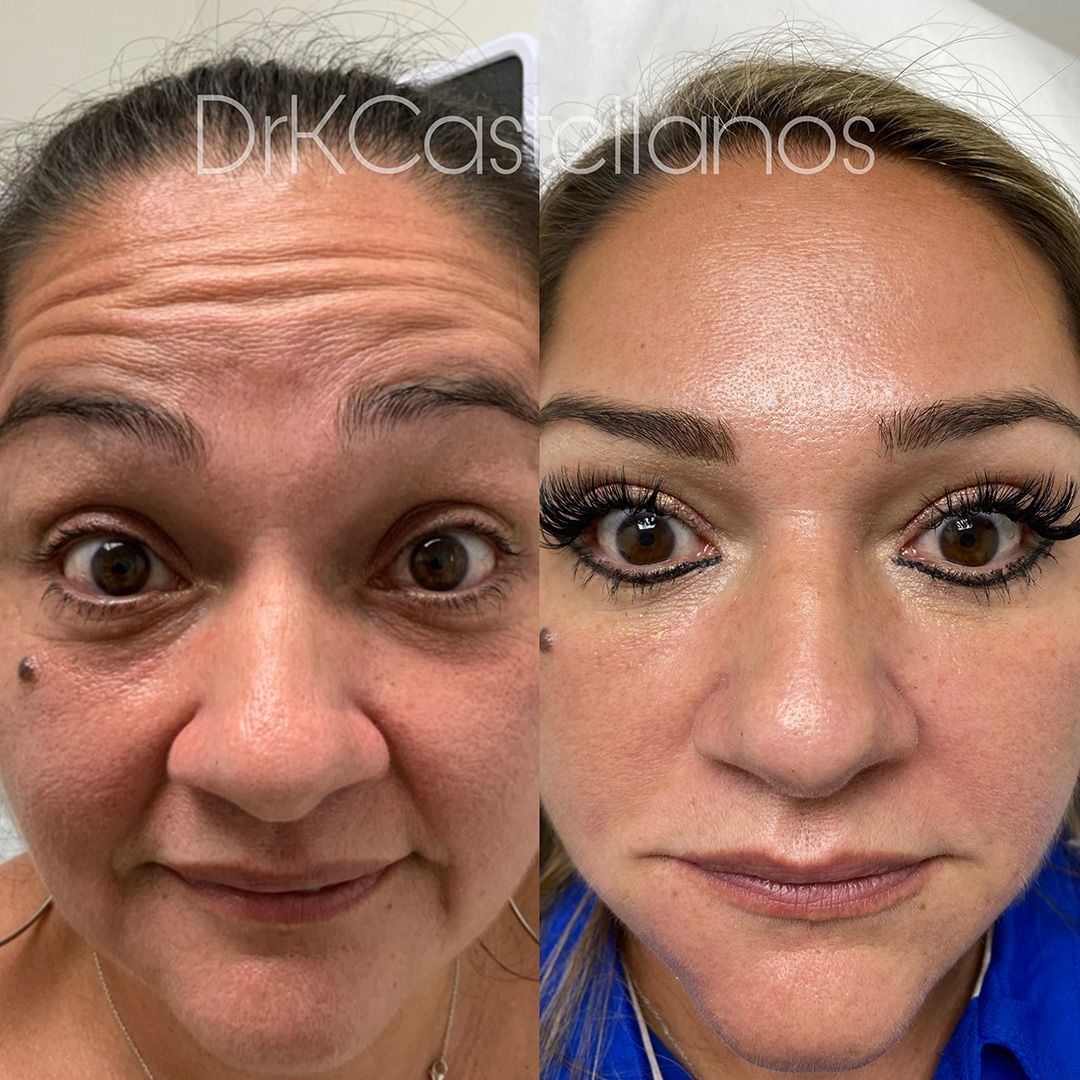 Before and after comparison of a woman’s forehead and eye area, showing reduced wrinkles after cosmetic treatment.