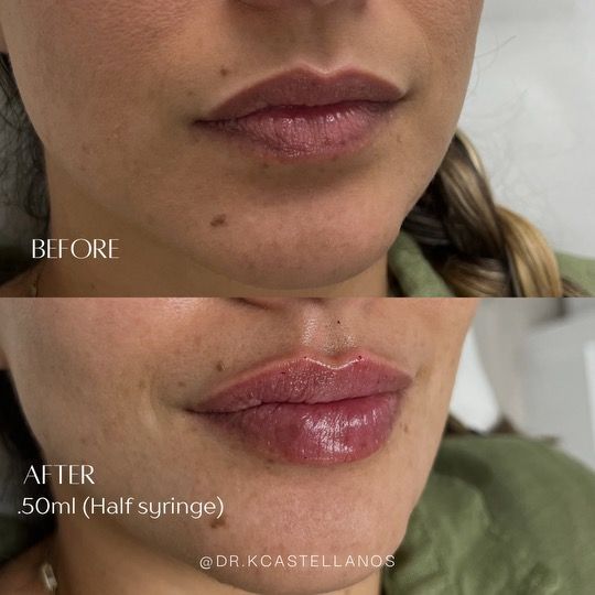 Before and after comparison of lips following a 0.50ml dermal filler injection, showing increased fullness and definition.