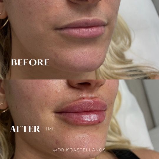 Before-and-after comparison of a person's lips, showing an increase in volume after a 1ml filler treatment.