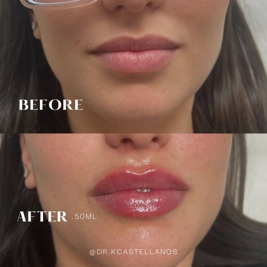Before and after comparison of lips before and after a 0.50ml dermal filler treatment.
