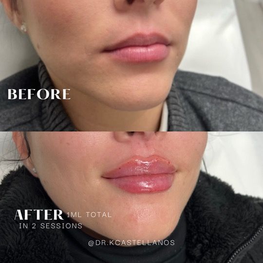 Before and after comparison of lips treated with 1ml of filler over two sessions.