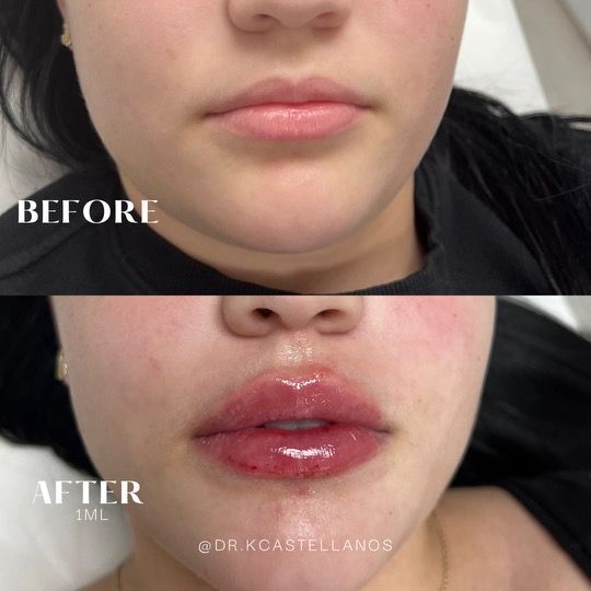 Before and after comparison of lips following a 1ml dermal filler treatment.