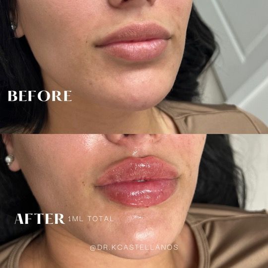 Before and after view of lips treated with 1ml of dermal filler, showing increased volume and definition.