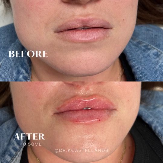 Before and after photos of lips treated with 0.50ml of dermal filler, showing increased volume and definition.