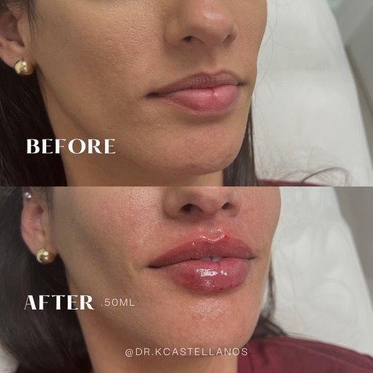 A before-and-after comparison of a person's lips showing the results of a 0.50ml lip filler cosmetic procedure.