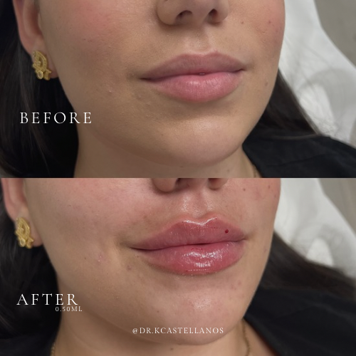 Before and after photos showing lip filler