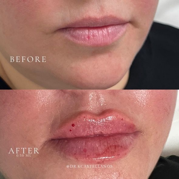 A before-and-after comparison of a person's lips showing the results of a cosmetic lip filler treatment.