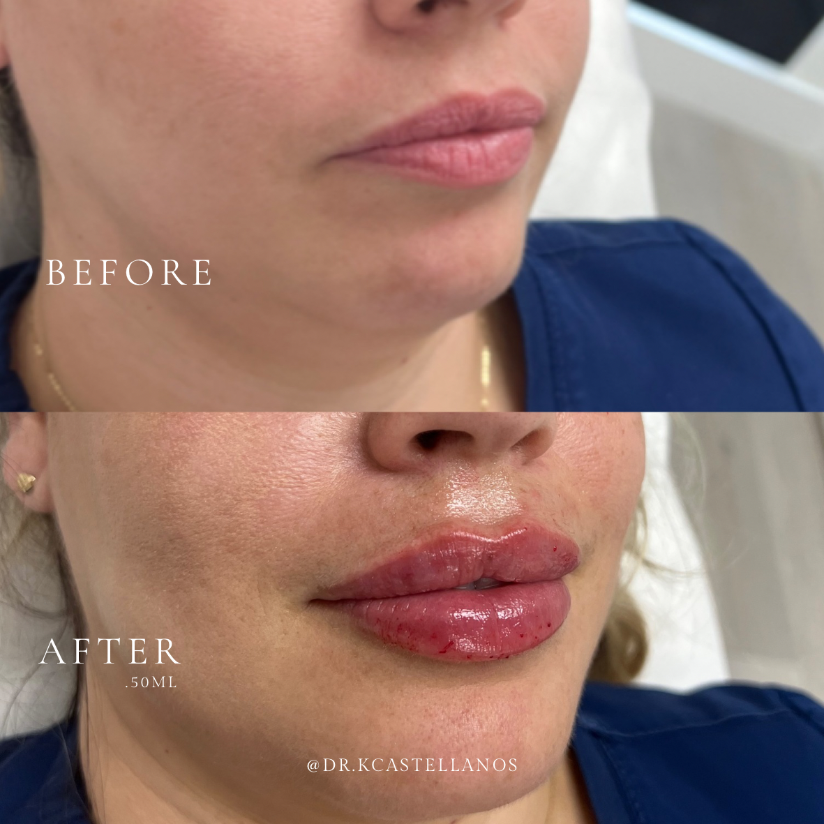 Before and after photo comparison showing a lip filler procedure with increased volume and definition.
