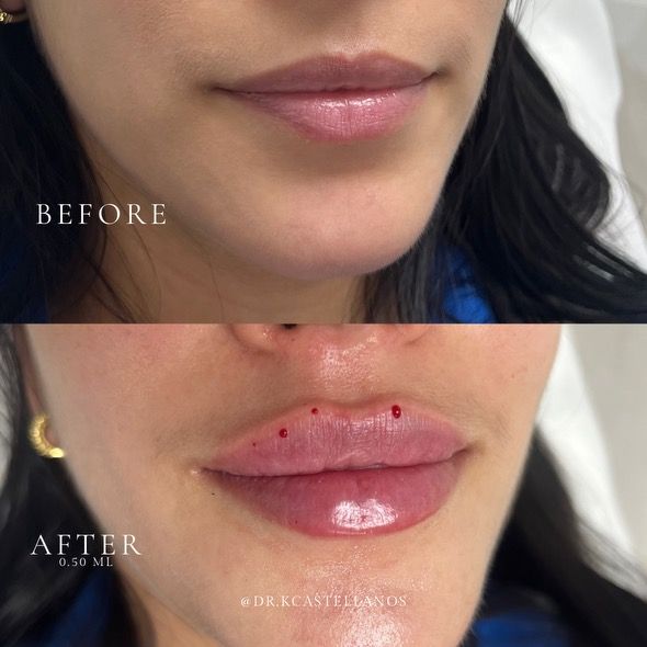 Before-and-after comparison of a lip filler procedure showing increased volume, with small puncture marks visible.