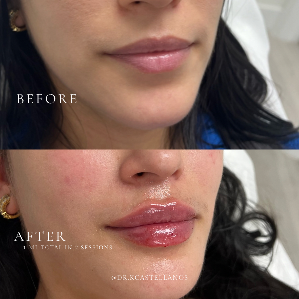 Before and after comparison of lip filler treatment, showing a subtle increase in volume and definition.