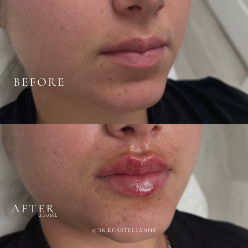 Before and after view of lips, showing an increase in volume and definition following a cosmetic filler procedure.