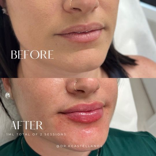 Before-and-after comparison showing lip filler results, with fuller, more defined lips after two sessions totaling 1ml.