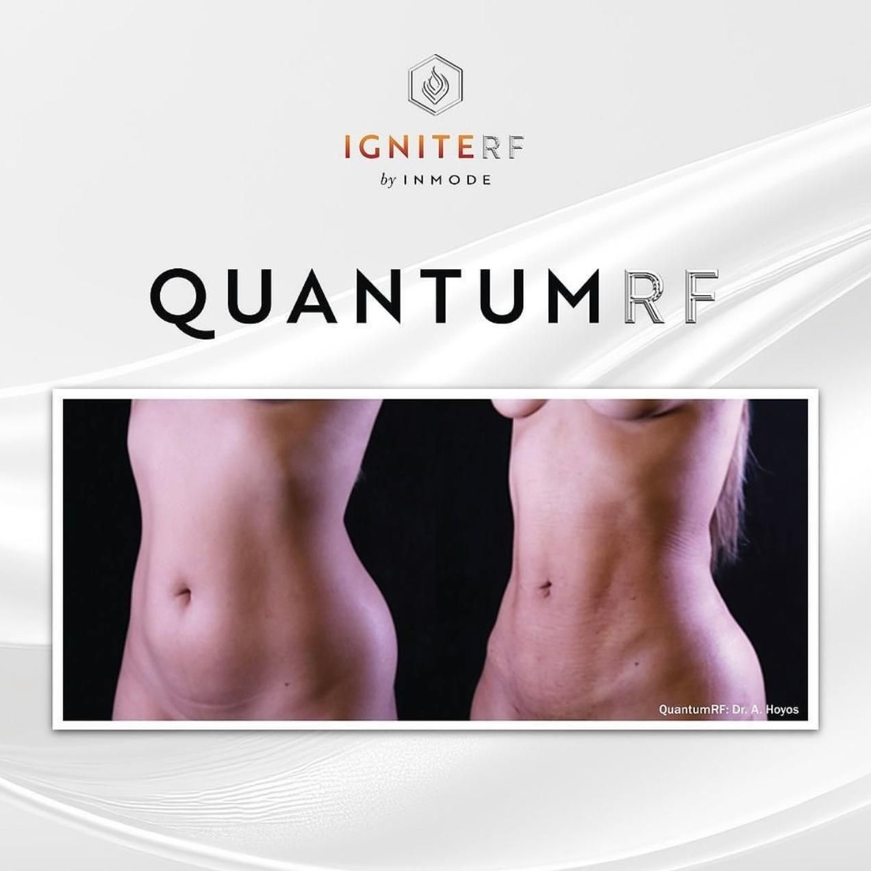 Before and after comparison of a torso showing results from IgniteRF QuantumRF body contouring treatment.