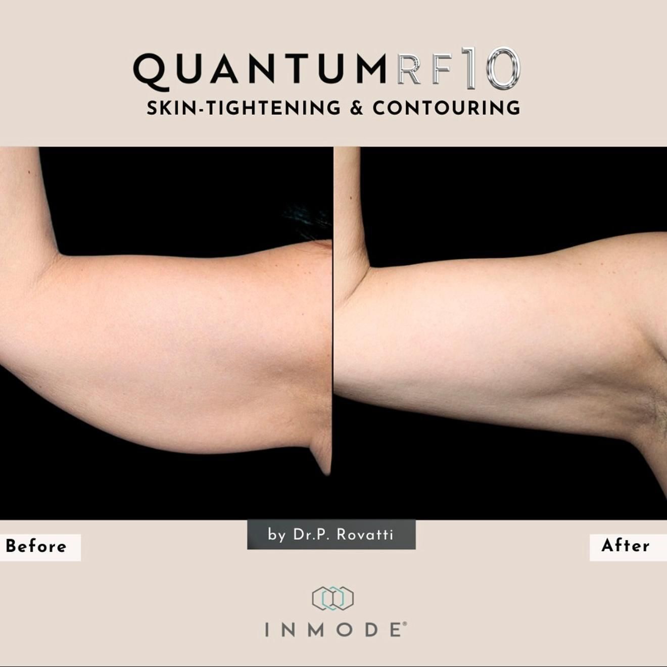 Before-and-after comparison of a person's upper arm showing skin tightening and contouring after a Quantum RF10 treatment.