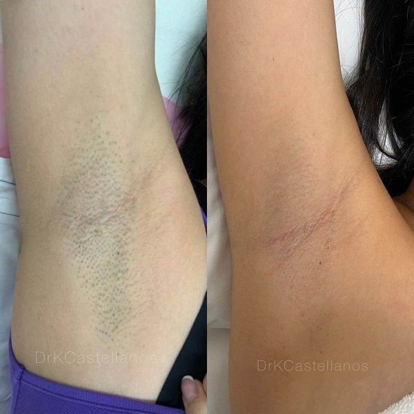 Before and after comparison of an underarm showing significant reduction in hair and skin pigmentation.