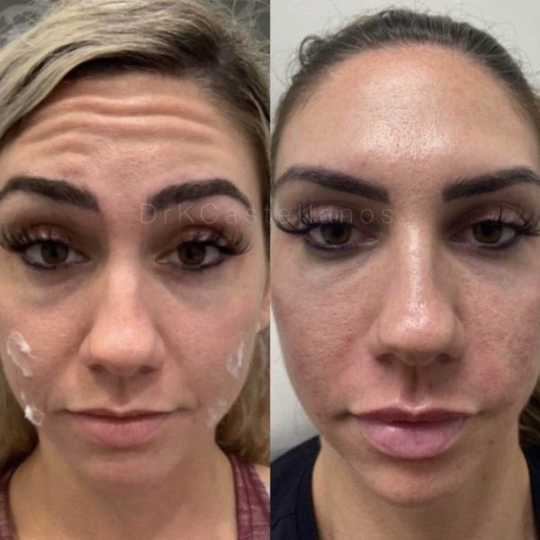 Before and after photos showing forehead muscle activity before and after cosmetic treatment.