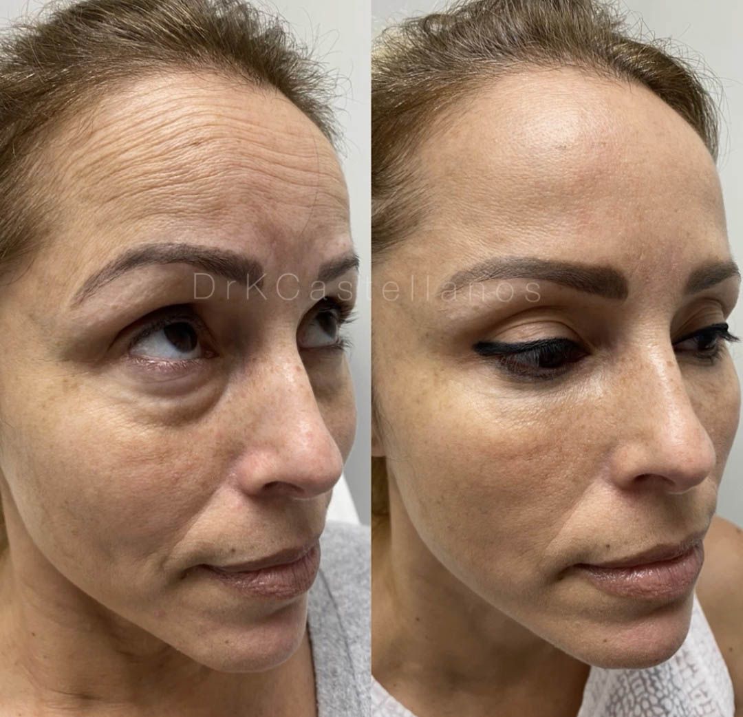 Before and after comparison of a person's forehead, showing a reduction in wrinkles after a cosmetic procedure.