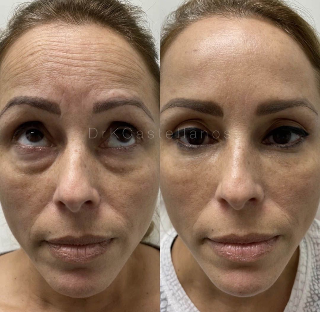 Before and after comparison of a woman's face showing reduction in forehead wrinkles and under-eye shadows.