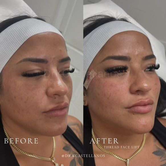 Before and after comparison of a patient’s face, demonstrating the results of a thread facelift procedure.
