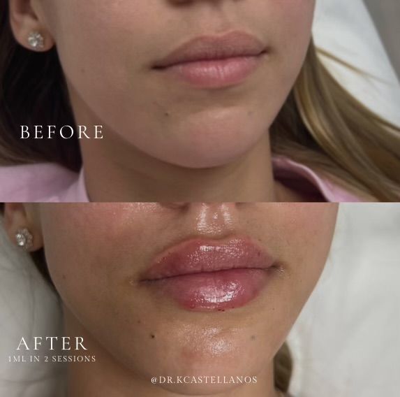 Before and after comparison showing lip filler results, highlighting increased volume and definition.