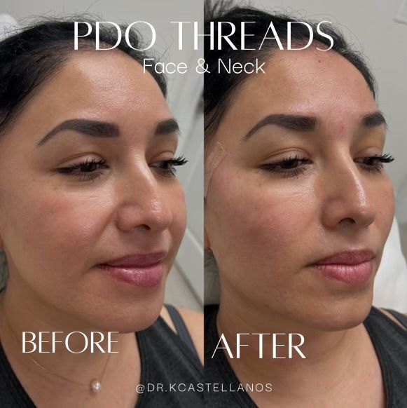 A side-by-side comparison showing facial skin before and after PDO thread treatment, demonstrating reduced lines.