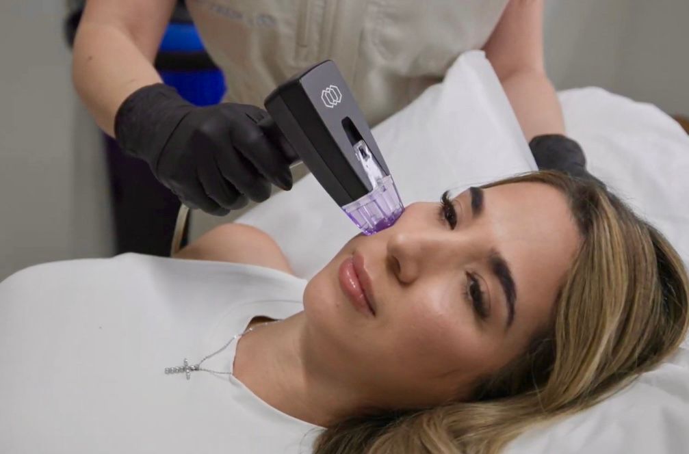 Morpheus8 perform a skin treatment on a person’s face.