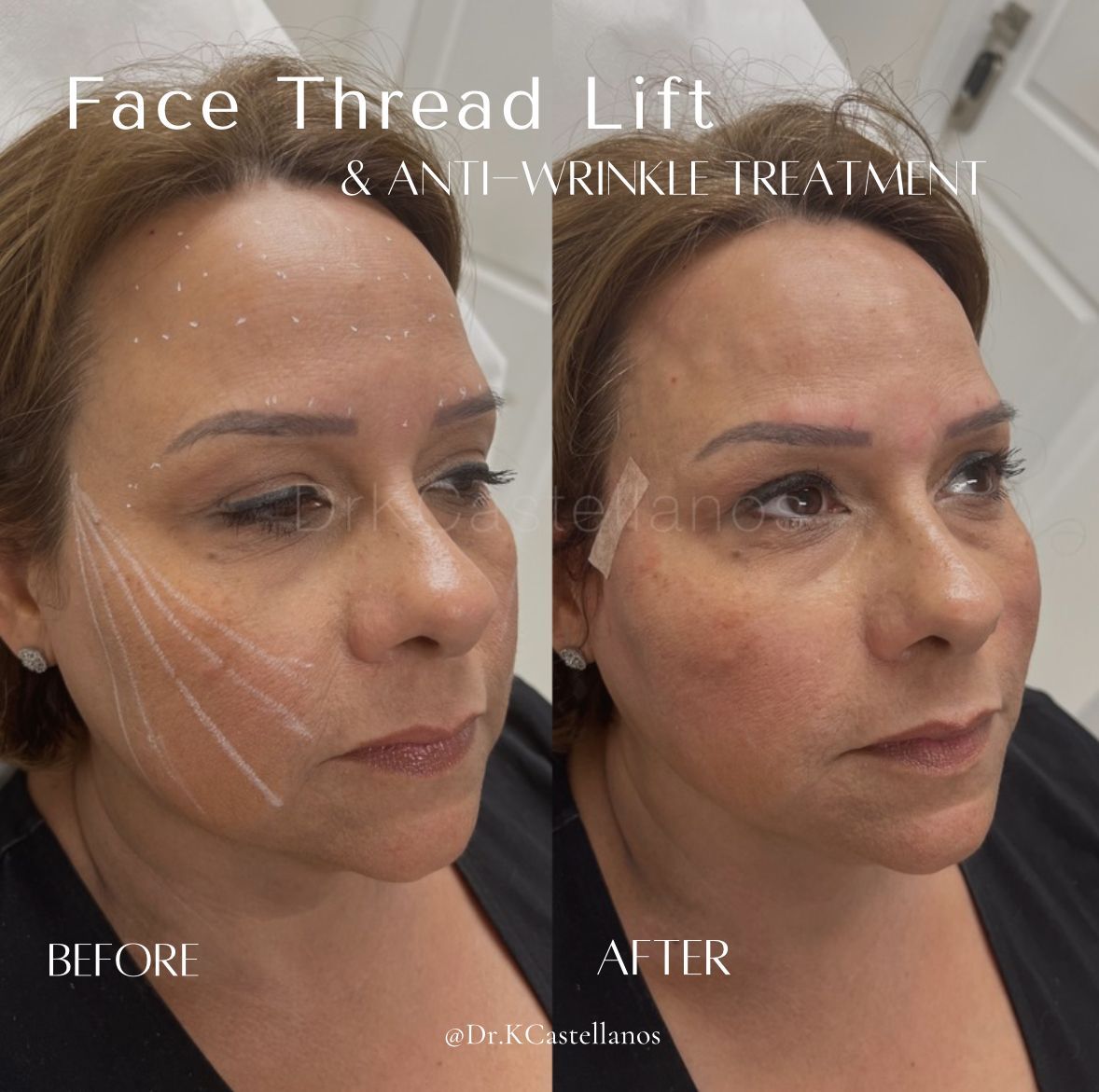 Before-and-after comparison of a face thread lift and anti-wrinkle treatment showing markers and facial contours.