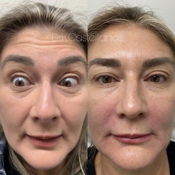 Before-and-after comparison showing a reduction in forehead and under-eye wrinkles after cosmetic treatment.
