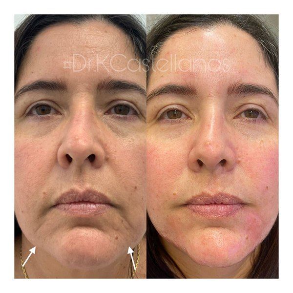 Before and after comparison showing facial filler treatment results, highlighting reduced marionette lines near the mouth.