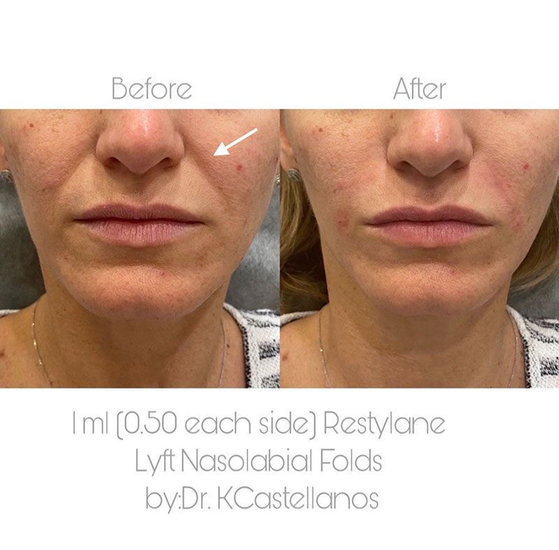 Before and after comparison of nasolabial fold treatment using 1ml of Restylane Lyft, showing a reduction in smile lines.