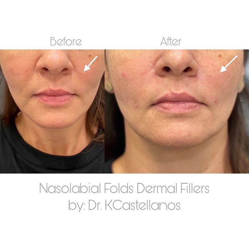 Before-and-after comparison showing the reduction of nasolabial folds using dermal fillers by Dr. KCastellanos.
