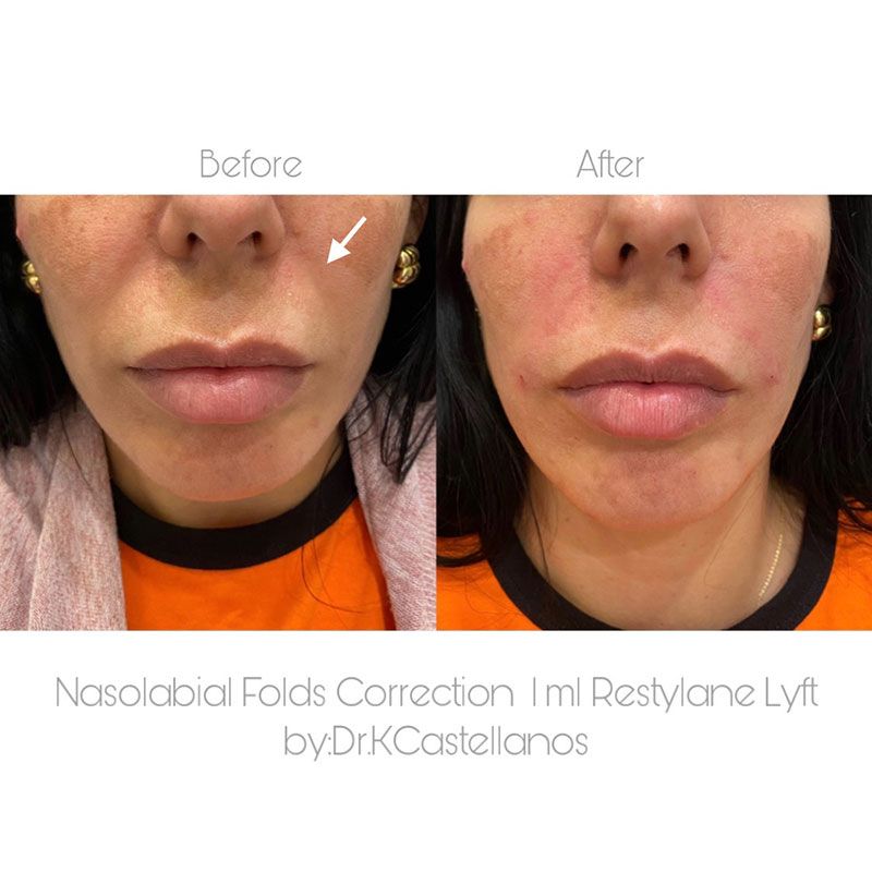 Before and after photos showing a reduction in nasolabial folds after receiving 1ml of Restylane Lyft filler.
