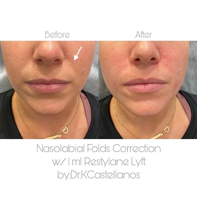 Before and after comparison of nasolabial fold filler treatment using Restylane Lyft.