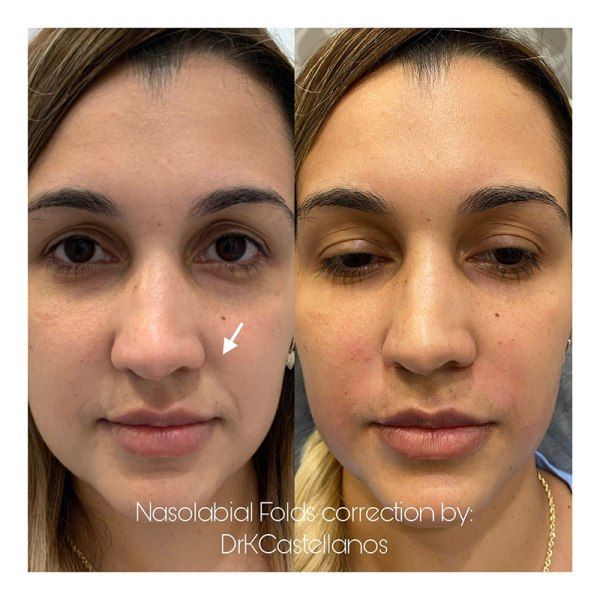 Before and after comparison of nasolabial fold correction with a dermal filler treatment by Dr. K. Castellanos.
