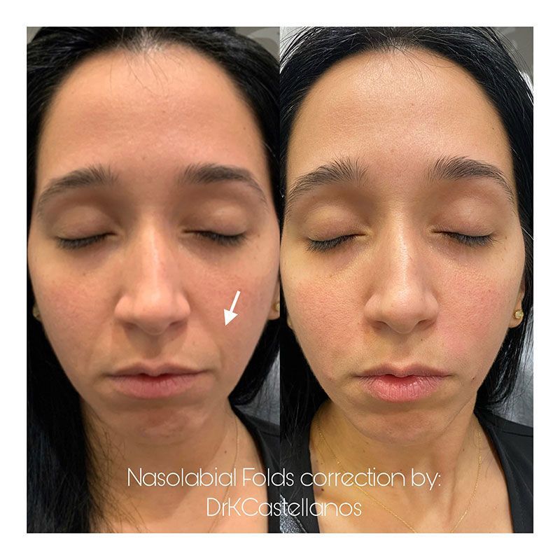 Before and after comparison showing the correction of nasolabial folds on a person's face.