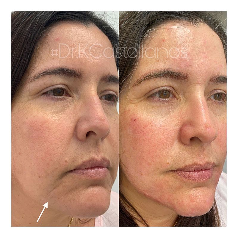 Before and after comparison of a person's lower face showing reduced marionette lines after a cosmetic treatment.