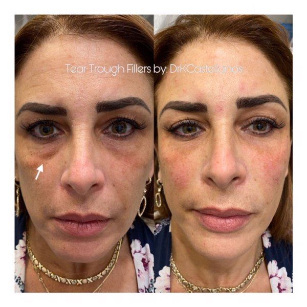 Before and after comparison of a person's tear trough area following cosmetic filler treatment.