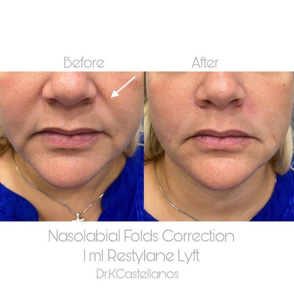 Before and after photos showing reduced nasolabial folds after 1ml of Restylane Lyft treatment.