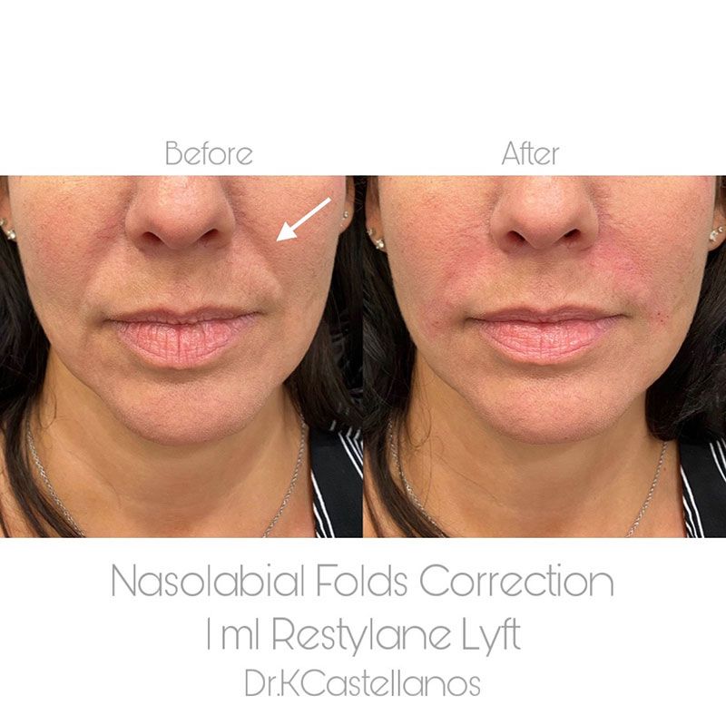 A before-and-after comparison of a person's face showing the reduction of nasolabial folds after dermal filler treatment.