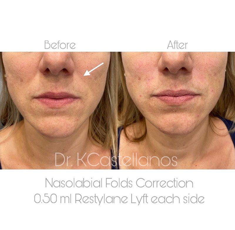Before and after comparison of nasolabial fold correction using 0.50 ml of Restylane Lyft on each side of the face.