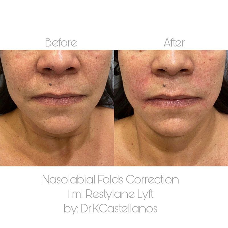Before and after comparison of nasolabial fold correction using 1ml of Restylane Lyft by Dr. K. Castellanos.