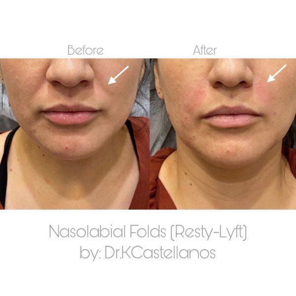 Before and after comparison of nasolabial folds treated with Restylane-Lyft by Dr. K. Castellanos.