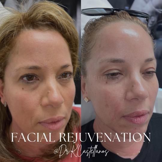 Before and after photos of a person’s face showing the results of a cosmetic facial rejuvenation treatment.