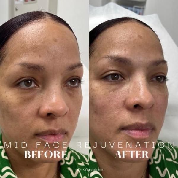 A before-and-after comparison showing facial changes following a mid-face rejuvenation procedure.