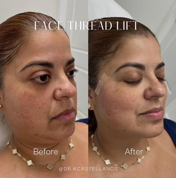 Before and after comparison of a patient’s face after a thread lift procedure, showing reduced skin laxity.