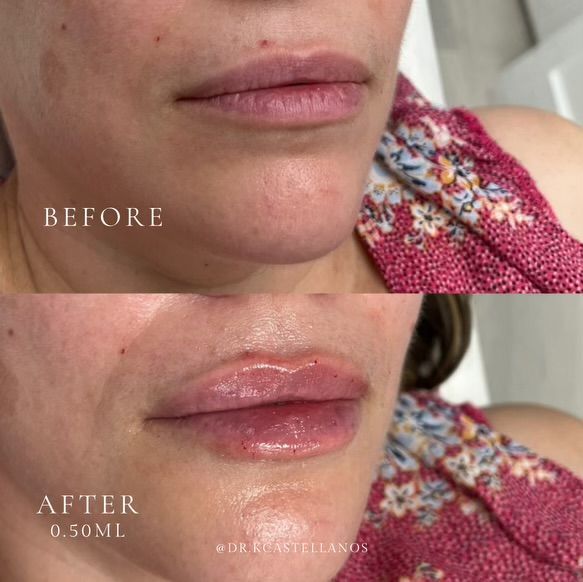 Before and after comparison of lips following a 0.50mL dermal filler treatment.
