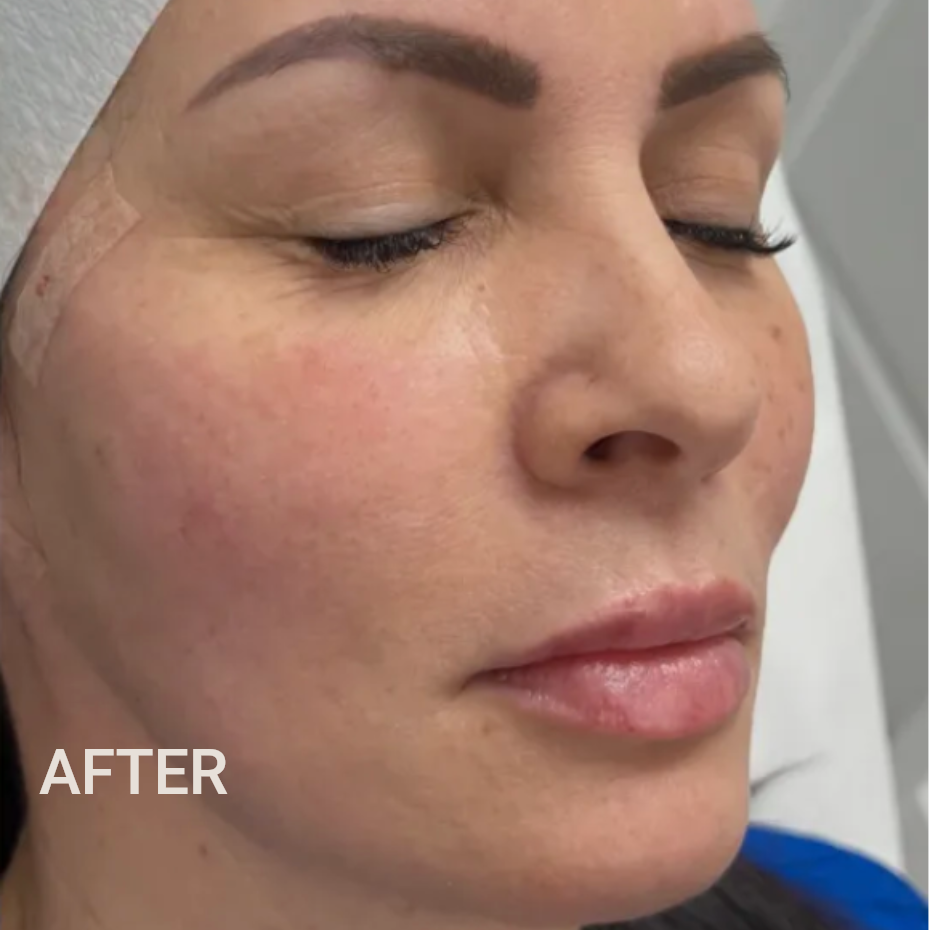 A close-up view of a person's profile in a clinical setting, showing smooth, clear skin