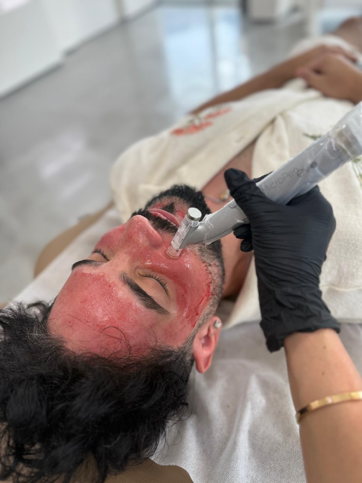 A person receiving a microneedling treatment with a device on their face, which is covered in a red serum.