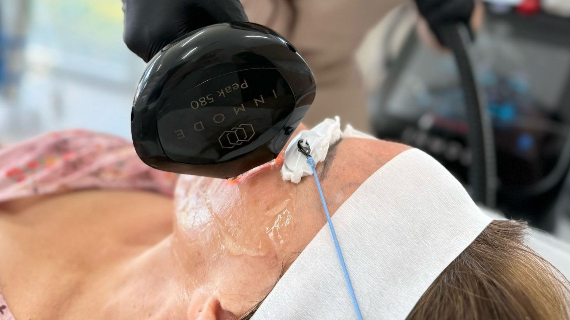 A provider performs a laser treatment on a patientโs face using an InMode Lumecca handpiece.