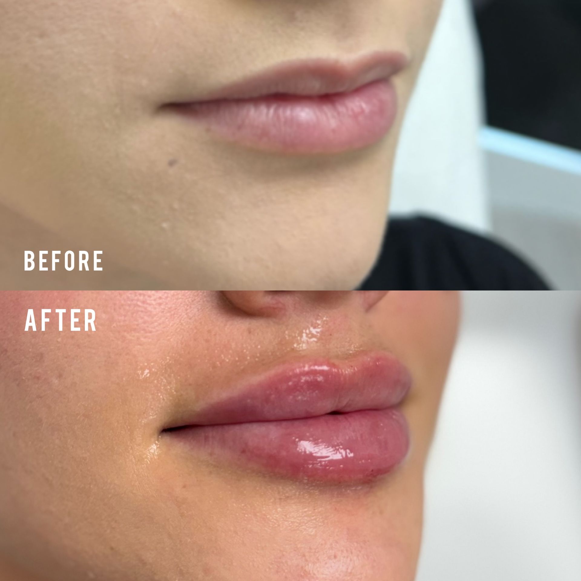 A split-screen comparison showing lips before and after receiving cosmetic filler injections, highlighting increased volume.